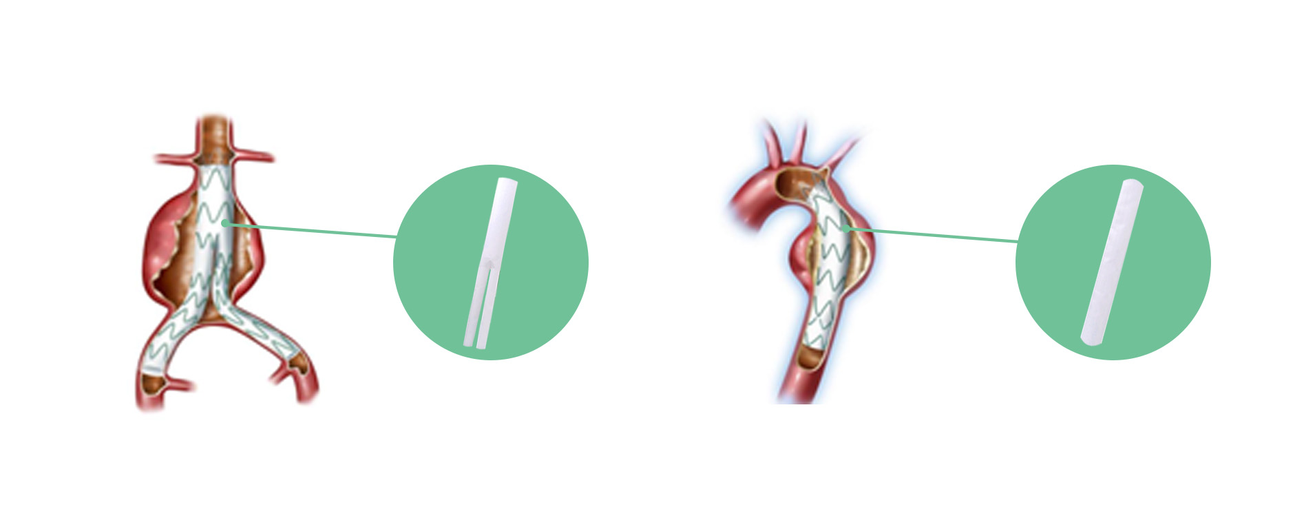 1755481298164743.jpg 官网覆膜支架.jpg